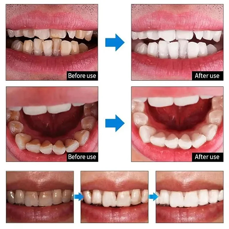 5D Teeth Whitening Strips