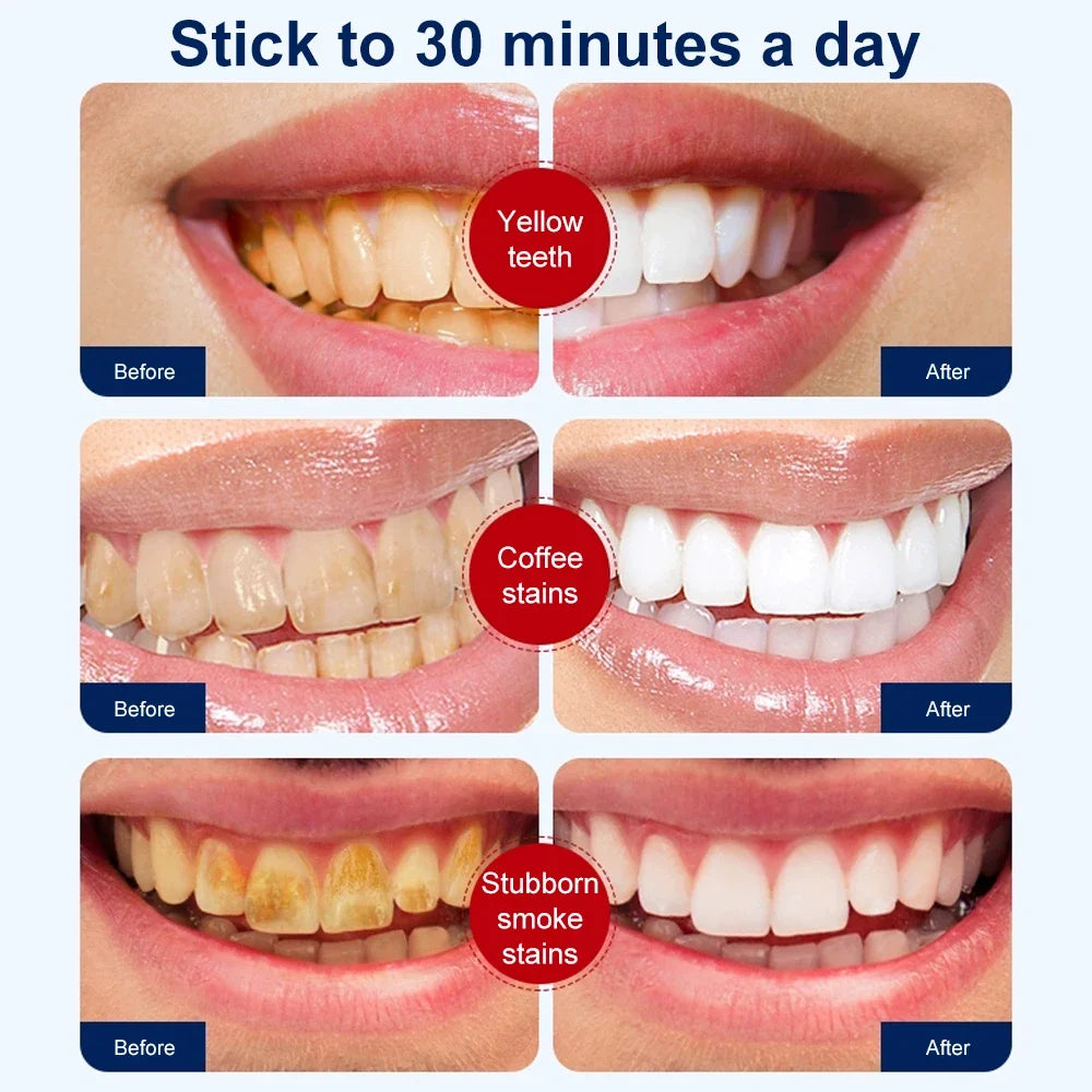 5D Teeth Whitening Strips